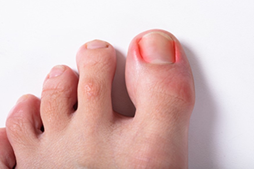 ingrown toenails