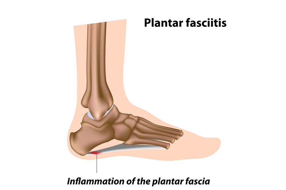 plantar fasciitis foot bone ss