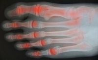 Arthritis: What Causes It & How to Treat It